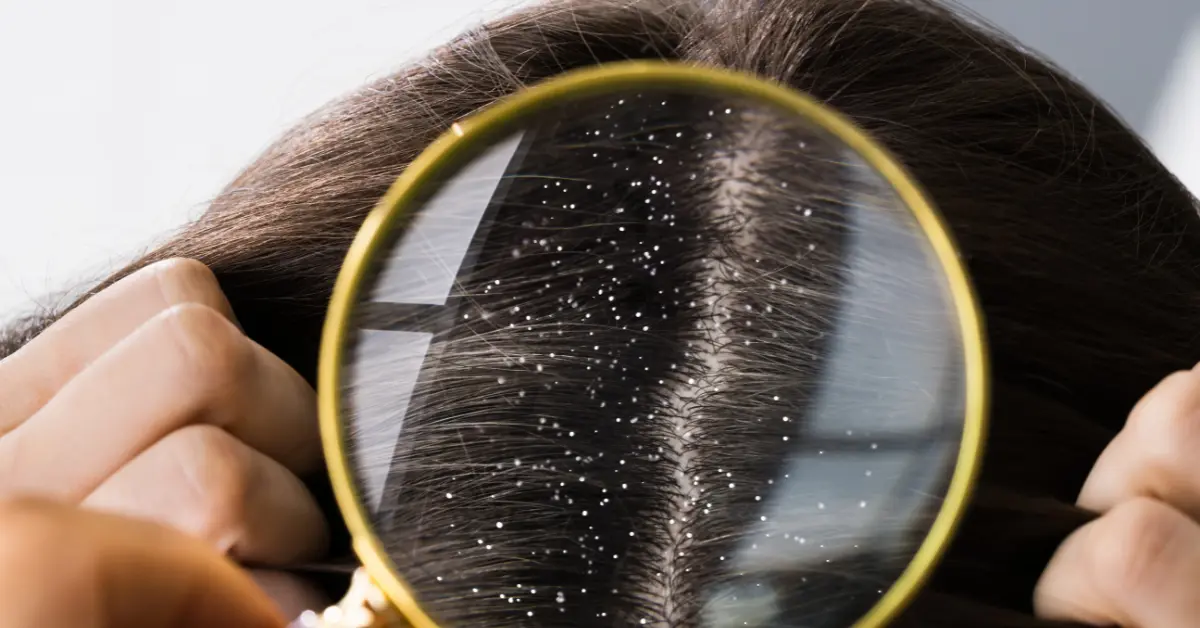 Dandruff